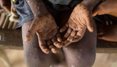 Kampala Leads in New Mpox Cases