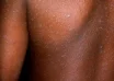 Kyegegwa District Confirms Measles Outbreak