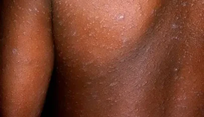 Kyegegwa District Confirms Measles Outbreak