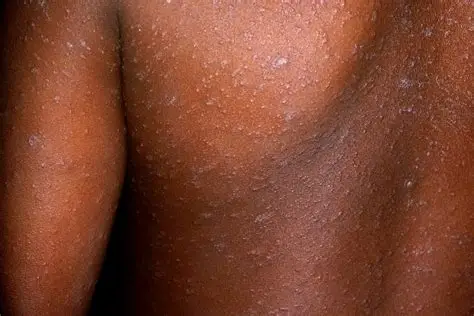Kyegegwa District Confirms Measles Outbreak