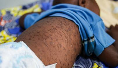 Almost Half of African Countries Battling Measles Outbreaks