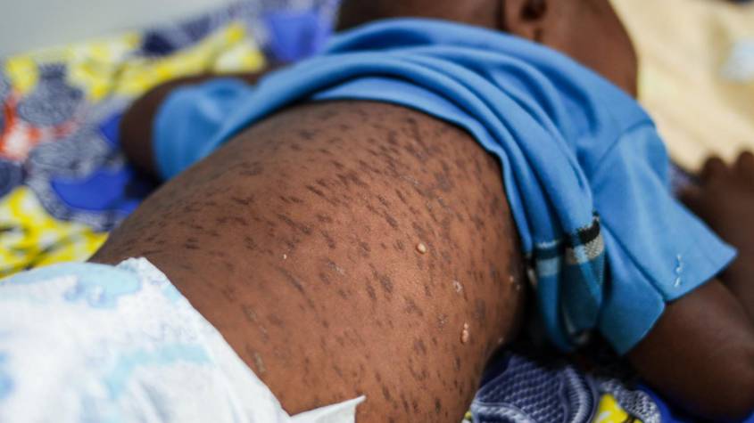 Almost Half of African Countries Battling Measles Outbreaks