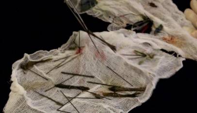 Surgeons Take 8 Hours to Extract 50 Needles inside Tortured Boy's Stomach